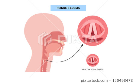 Reinkes edema poster 130498478