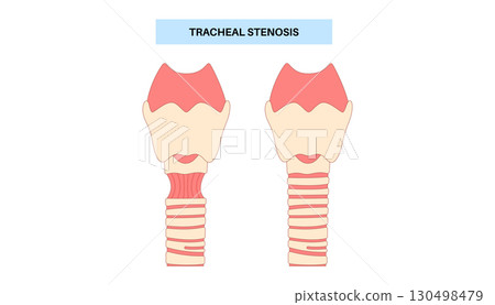 Tracheal stenosis poster 130498479