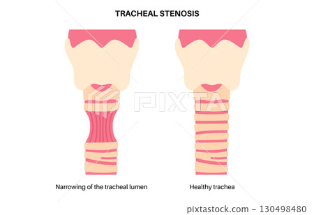 Tracheal stenosis poster Tracheal stenosis poster 130498480