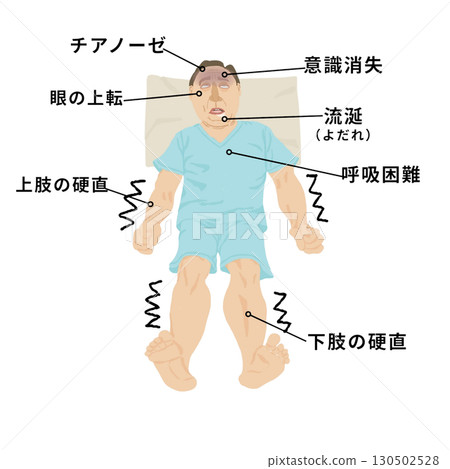 醫學插圖 | 癲癇症狀（意識喪失、眼球向上移動、發紺、呼吸困難）教育材料 130502528