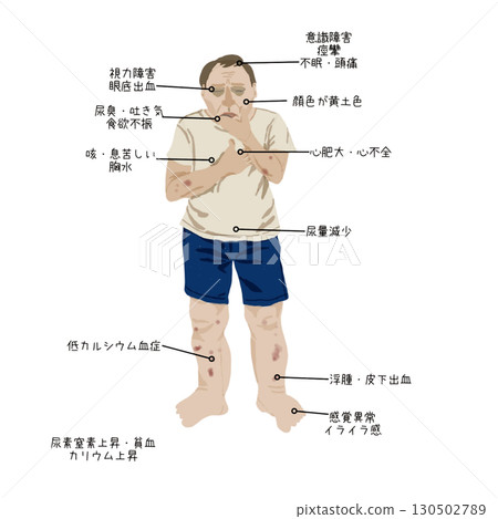 醫學插圖|腎衰竭患者的症狀(皮膚變化、疲勞、水腫)教育資料 醫學插圖|腎衰竭患者的症狀(皮膚變化、疲勞、水腫)教育資料 130502789