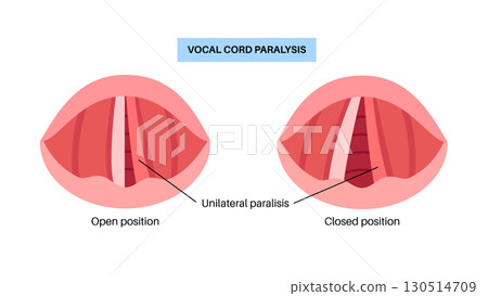Vocal cords paralysis 130514709
