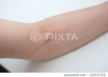 Arm after blood collection 130517720