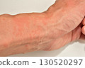 A wrist with numerous rashes caused by caterpillar bites 130520297