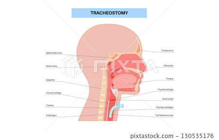 Tracheostomy medical poster Tracheostomy medical poster 130535176
