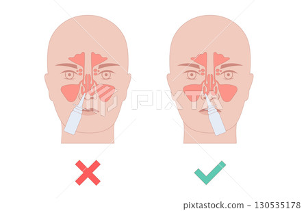 Proper nasal spray usage Proper nasal spray usage 130535178