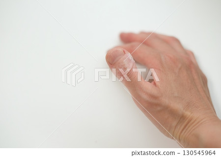 Thumb after removing bandage 130545964