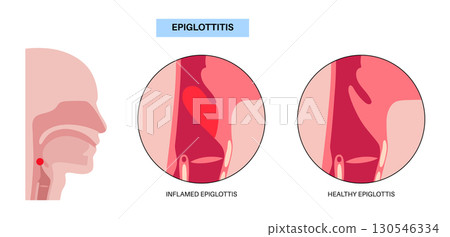 Epiglottitis medical poster 130546334