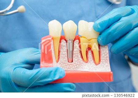 Dentist holding dental implant, artificial tooth roots into jaw, root canal of dental treatment, gum disease, teeth model for dentist. Dentist holding dental implant, artificial tooth roots into jaw, root canal of dental treatment, gum disease, teeth model for dentist. 130546922