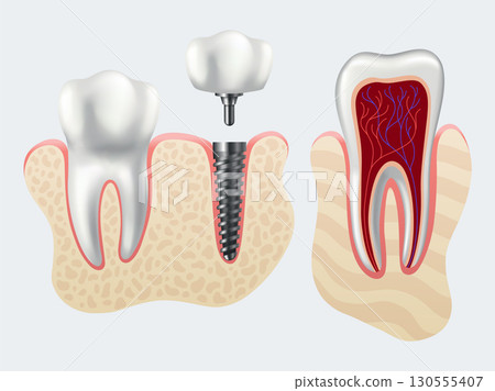 Dental implant structure. Medical educative infographic poster. Teeth implant, realistic vector design of dentistry. Implant screw, healthcare, dentist and orthodontist treatment Dental implant structure. Medical educative infographic poster. Teeth implant, realistic vector design of dentistry. Implant screw, healthcare, dentist and orthodontist treatment 130555407