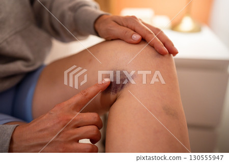 Woman examining leg bruises after physical impact, soft tissue damage and limb skin discoloration 130555947