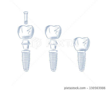 Tooth implant parts illustration blue 130563986