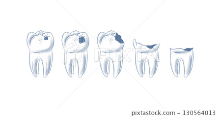 Life cycle of dental caries blue 130564013