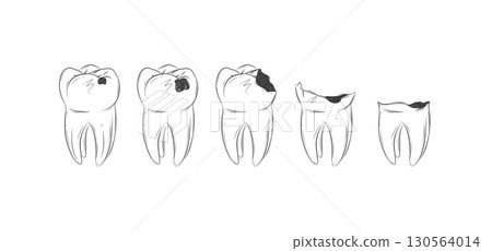 Life cycle of dental caries Life cycle of dental caries 130564014