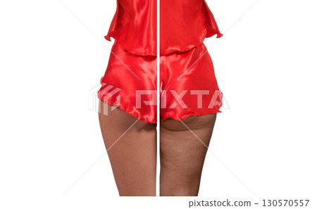Woman's thighs and buttocks with cellulite. Woman's thighs and buttocks with cellulite. 130570557