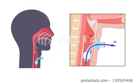 Tracheostomy medical poster 130585406
