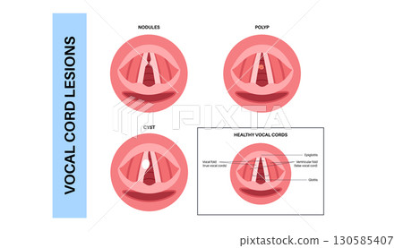 Vocal cord lesions Vocal cord lesions 130585407