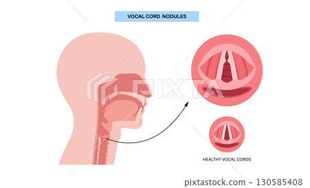 Vocal cord nodules 130585408