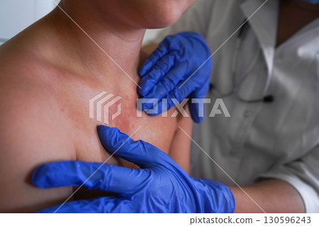 The boy's body displays signs of monkeypox infection. The boy's body displays signs of monkeypox infection. 130596243