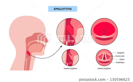Epiglottitis medical poster Epiglottitis medical poster 130596625