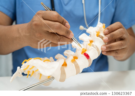 Asian doctor holding spinal nerve and bone model, Lumbar spine displaced herniated disc fragment for treatment medical in the orthopedic department. 130623367