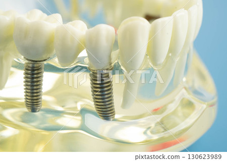 Dental implant, artificial tooth roots into jaw, root canal of dental treatment, gum disease, teeth model for dentist studying about dentistry. Dental implant, artificial tooth roots into jaw, root canal of dental treatment, gum disease, teeth model for dentist studying about dentistry. 130623989