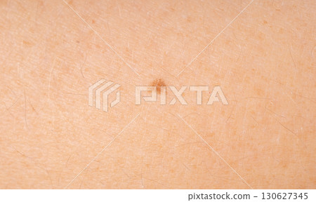 Skin mole spot closeup. Human birthmark, nevus macro texture Skin mole spot closeup. Human birthmark, nevus macro texture 130627345