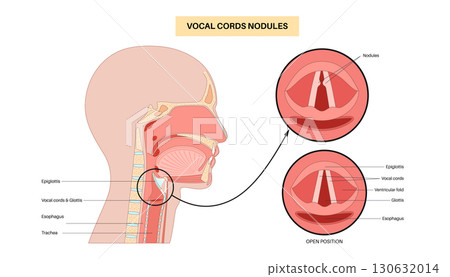 Vocal cord nodules Vocal cord nodules 130632014