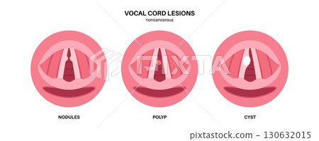 Vocal cord lesions Vocal cord lesions 130632015
