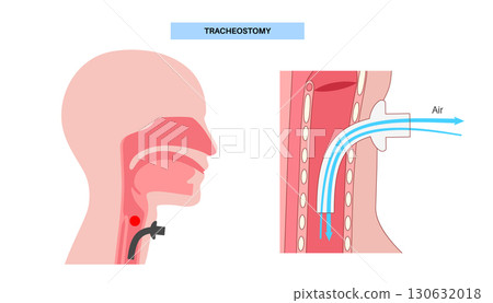 Tracheostomy medical poster 130632018