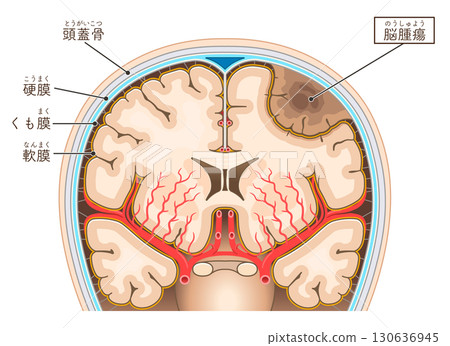腦腫瘤插圖 腦腫瘤插圖 130636945