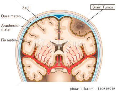 腦腫瘤插圖 130636946