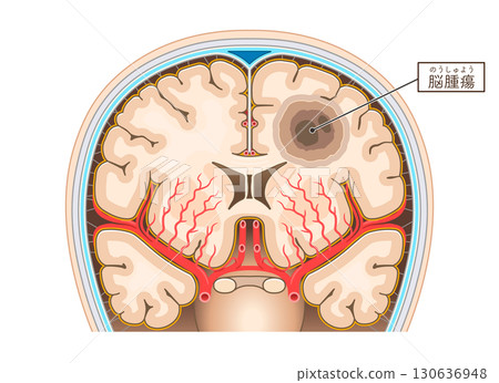 腦腫瘤插圖 130636948