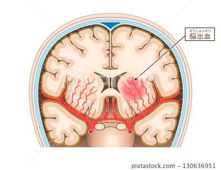 Illustration of cerebral hemorrhage Illustration of cerebral hemorrhage 130636951