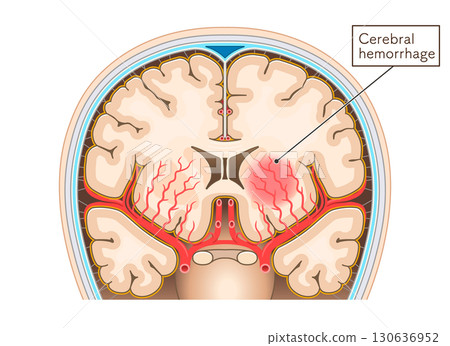 Illustration of cerebral hemorrhage Illustration of cerebral hemorrhage 130636952
