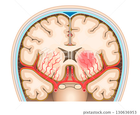 Illustration of cerebral hemorrhage Illustration of cerebral hemorrhage 130636953