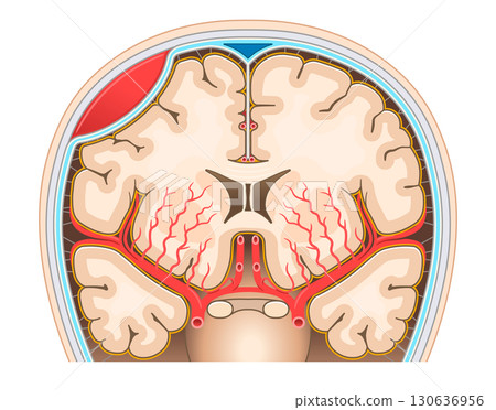 Illustration of an epidural hematoma 130636956