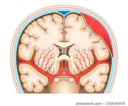 硬腦膜下血腫的圖示 硬腦膜下血腫的圖示 130636959