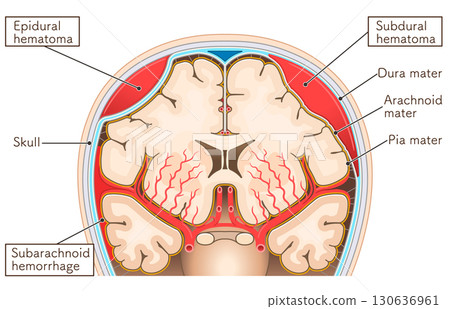 Illustrations of subarachnoid hemorrhage, epidural hematoma, and subdural hematoma Illustrations of subarachnoid hemorrhage, epidural hematoma, and subdural hematoma 130636961