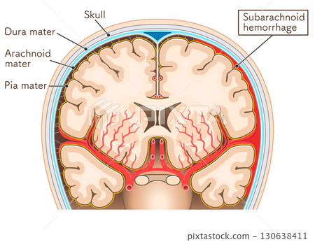 Illustration of subarachnoid hemorrhage Illustration of subarachnoid hemorrhage 130638411