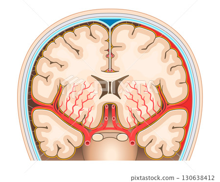 Illustration of subarachnoid hemorrhage 130638412