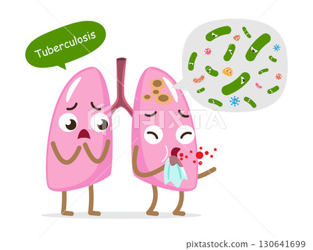 Pulmonary tuberculosis . TB lung cartoon character . Mycobacterium tuberculosis bacteria infected in apex of left lung . Isolated white background . Vector . Pulmonary tuberculosis . TB lung cartoon character . Mycobacterium tuberculosis bacteria infected in apex of left lung . Isolated white background . Vector . 130641699