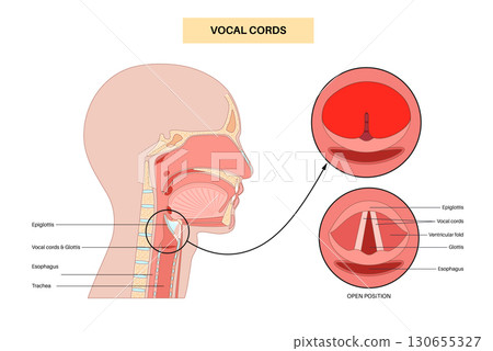 Epiglottitis medical poster 130655327