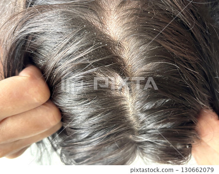 Brunette woman showing scalp psoriasis with flaking, redness, and irritation, top view close up. Dermatology, skin and scalp disease, psychosomatic disorders, medical condition, treatment and health Brunette woman showing scalp psoriasis with flaking, redness, and irritation, top view close up. Dermatology, skin and scalp disease, psychosomatic disorders, medical condition, treatment and health 130662079