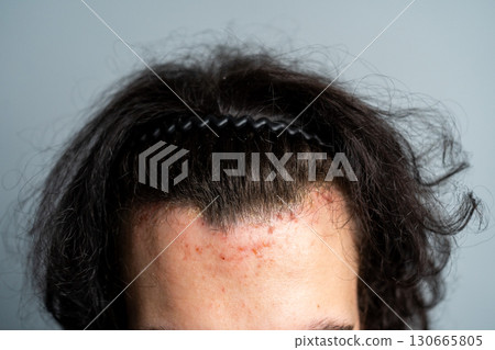 Close-up of a young man s forehead with acne and irritated skin near the hairline, isolated background. Close-up of a young man s forehead with acne and irritated skin near the hairline, isolated background. 130665805