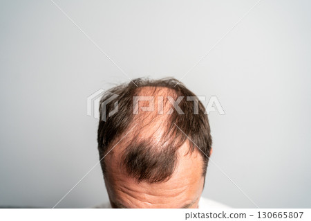 Close-up of a man with advanced hair loss and baldness on the top of the head, isolated on light background. Close-up of a man with advanced hair loss and baldness on the top of the head, isolated on light background. 130665807