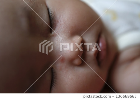特寫鏡頭：熟睡的嬰兒臉上有蚊蟲叮咬的痕跡 130669665