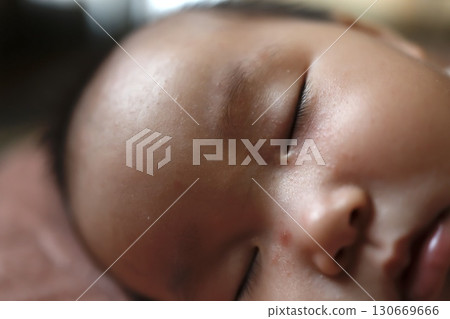 特寫鏡頭:熟睡的嬰兒臉上有蚊蟲叮咬的痕跡 特寫鏡頭:熟睡的嬰兒臉上有蚊蟲叮咬的痕跡 130669666