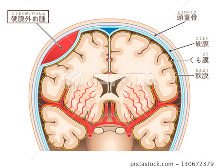硬腦膜外血腫的圖示 硬腦膜外血腫的圖示 130672379