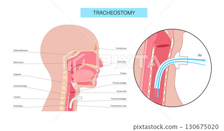 Tracheostomy medical poster 130675020